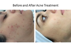 Acne-Treatments-Bucks
