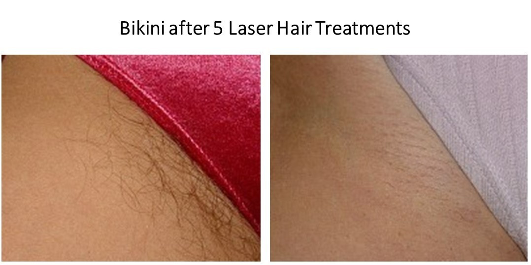 Bikini-Laser-Hair-JPG