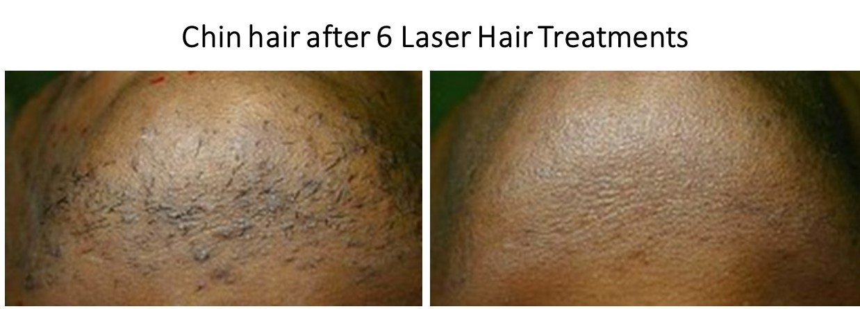 Chin-Laser-Hair-JPG