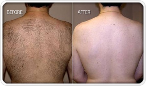 Laser-Hair-Removal-man-back