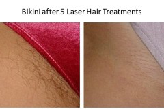 Bikini-Laser-Hair-JPG