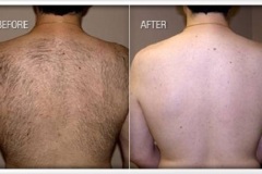 Laser-Hair-Removal-man-back