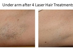 Underarm-Laser-Hair-JPG