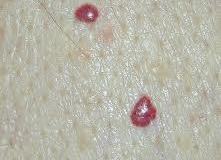 Cherry-Angioma-_-Blood-Spots