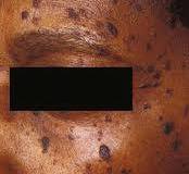 Dermatosis-papulosa