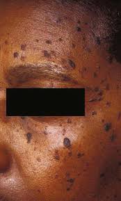 Dermatosis papulosa