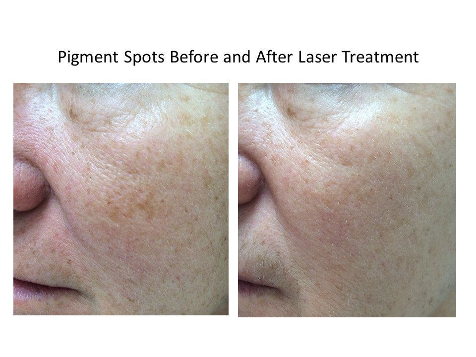 Face Pigments Results After Laser