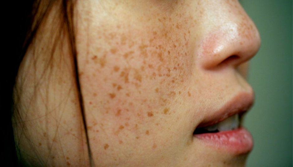 Face Sun Damge Freckles Pigmentation