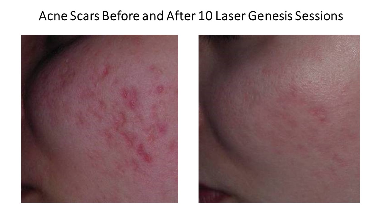 Laser Genesis Acne Scars jpeg