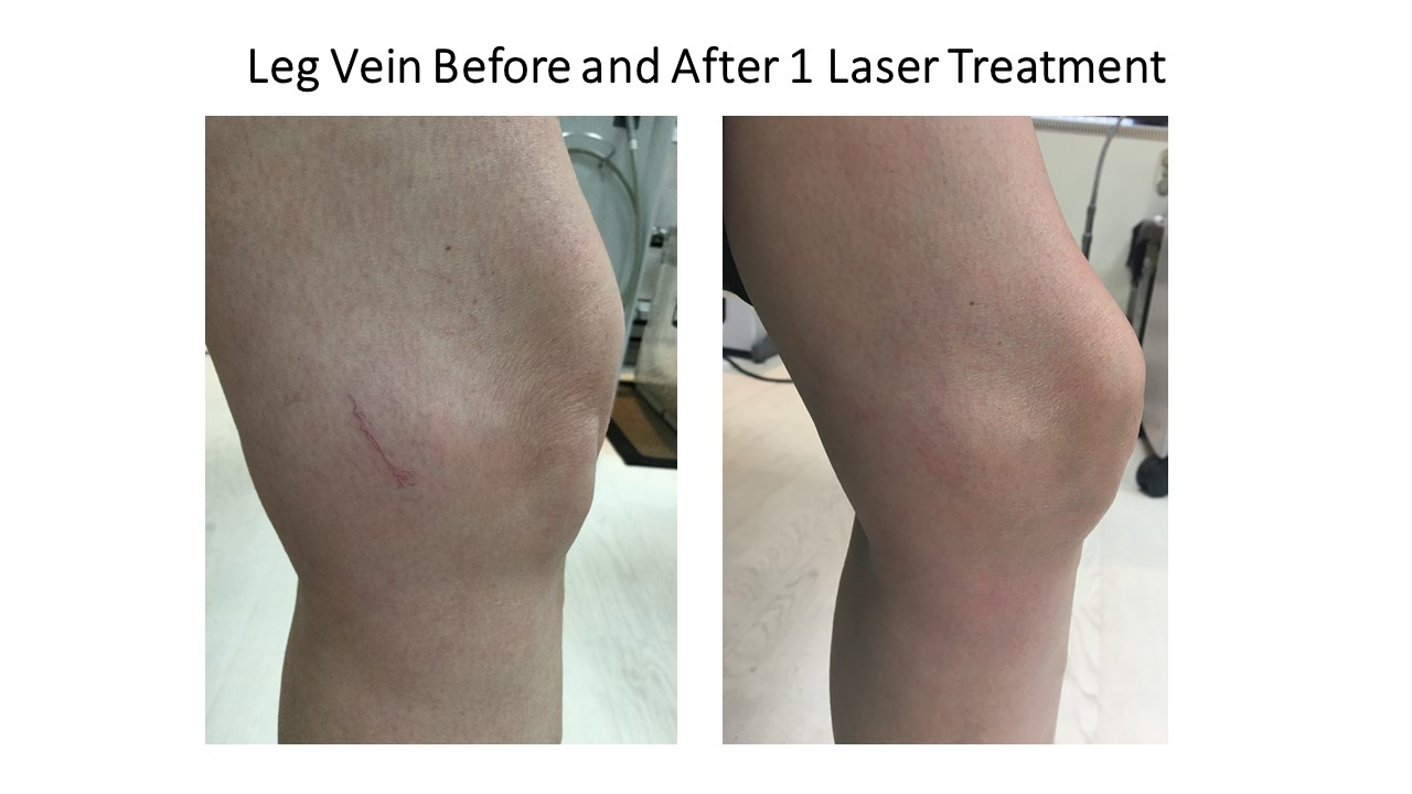 Leg Veins Results Photo