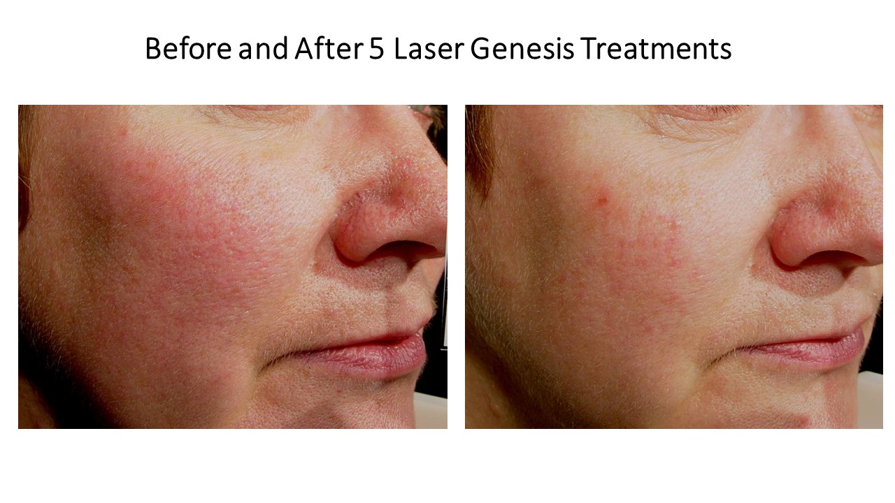 Rosacea Treatment Laser Genesis JPEG