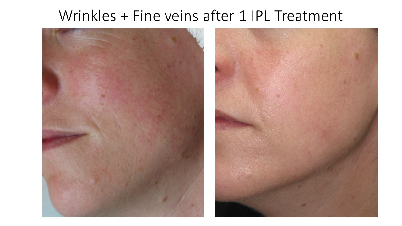 Skin treatments by IQ Skin & Laser